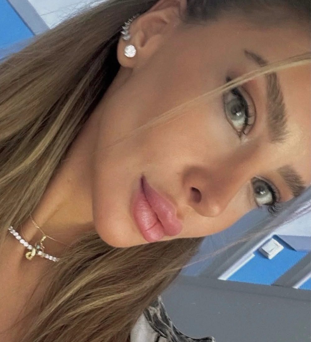 Long-term rhinoplasty result — Op. Dr. G. Arda Pelen