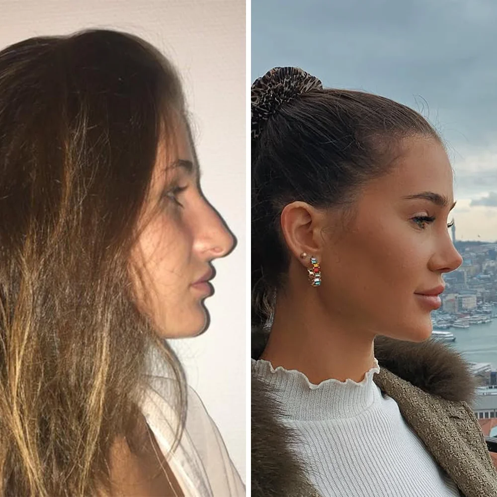 Rhinoplasty before and after — Op. Dr. G. Arda Pelen