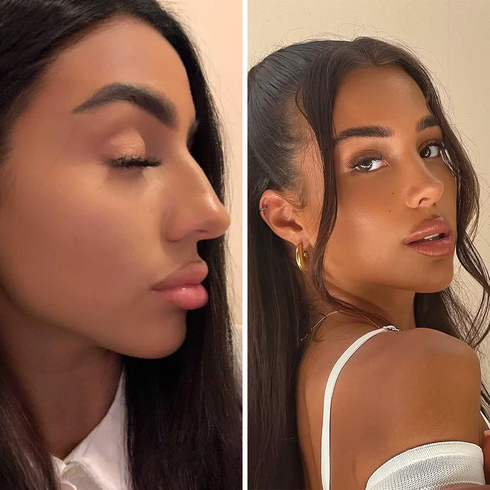 Rhinoplasty before and after — Op. Dr. G. Arda Pelen