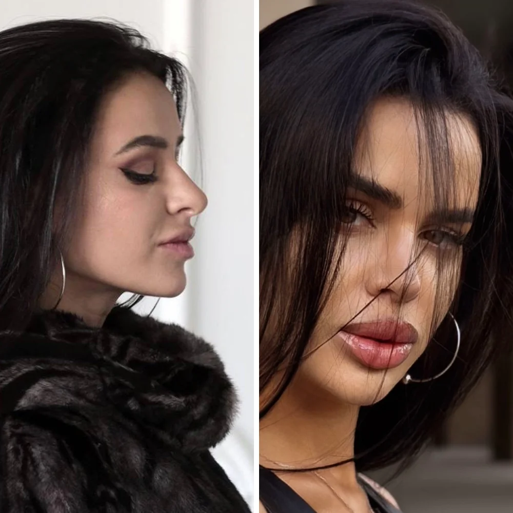 Rhinoplasty before and after — Op. Dr. G. Arda Pelen
