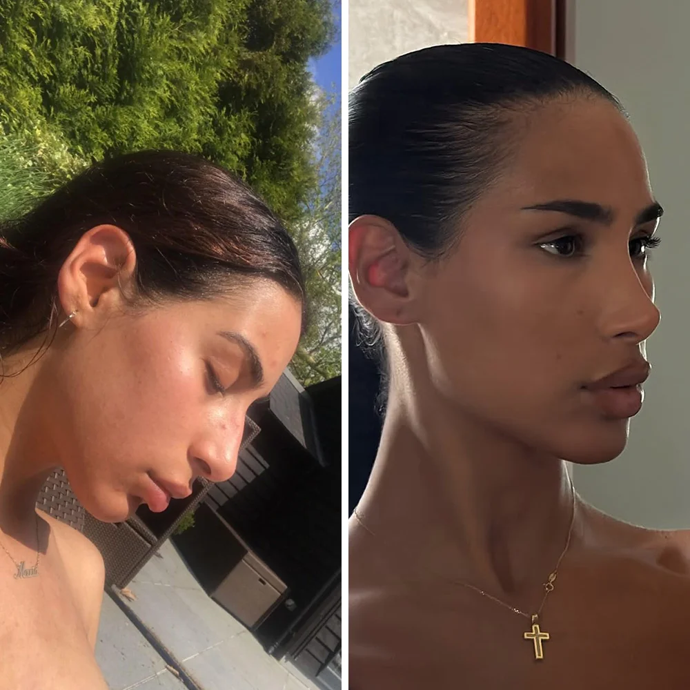 Rhinoplasty before and after — Op. Dr. G. Arda Pelen