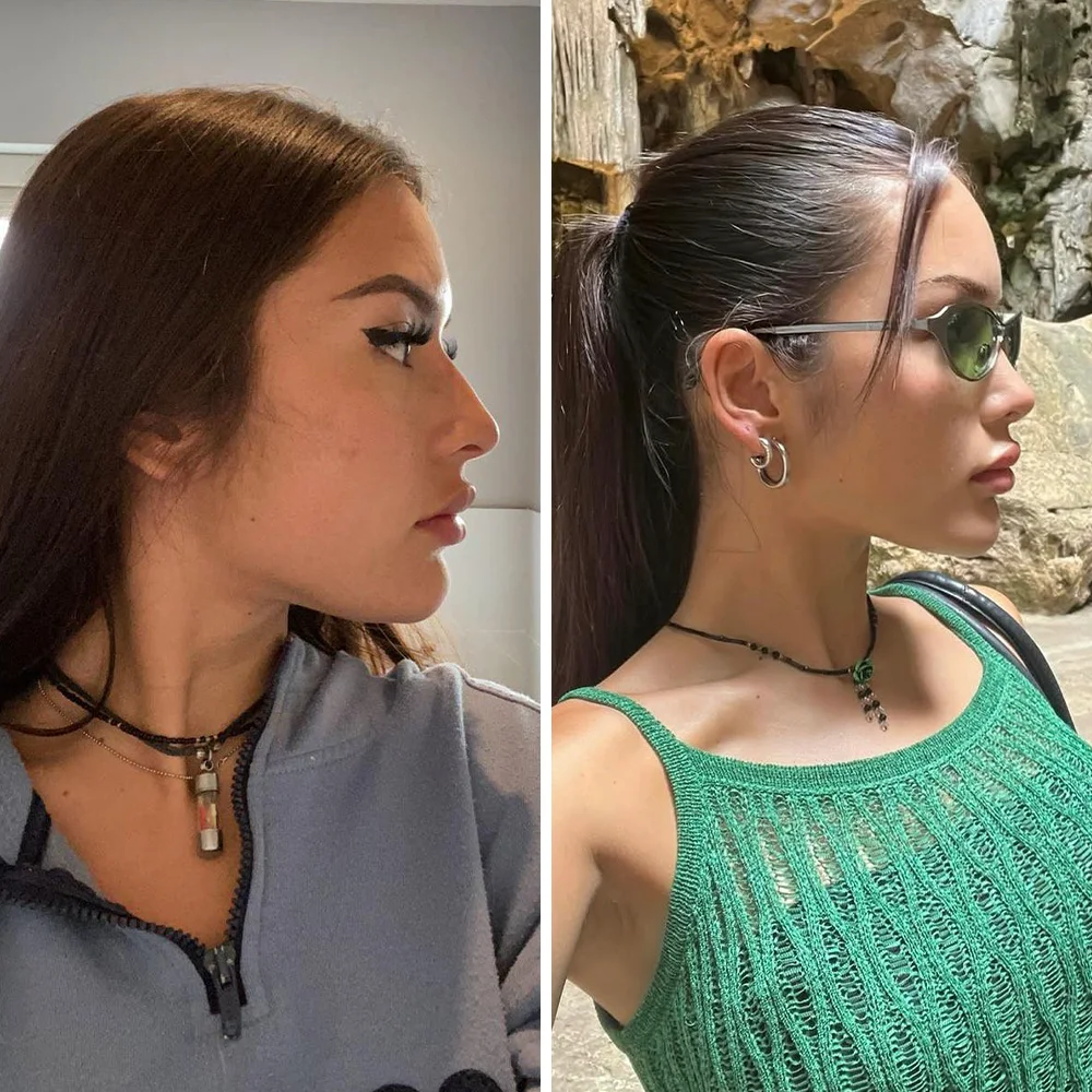 Rhinoplasty before and after — Op. Dr. G. Arda Pelen